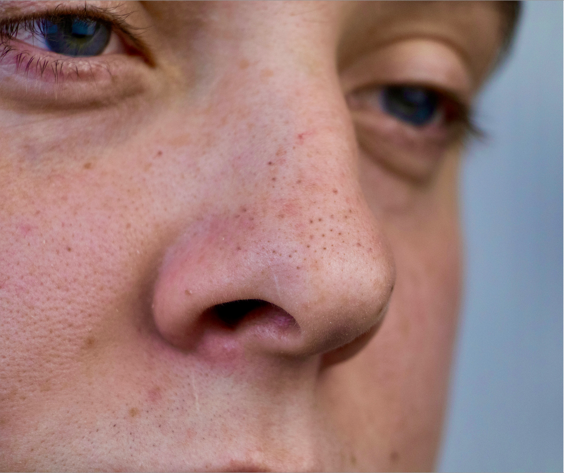 Minden, amit a mitesszerekről tudni érdemes – és hogyan szabadulhatsz meg tőlük hatékonyan