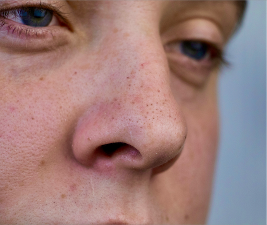 Minden, amit a mitesszerekről tudni érdemes – és hogyan szabadulhatsz meg tőlük hatékonyan